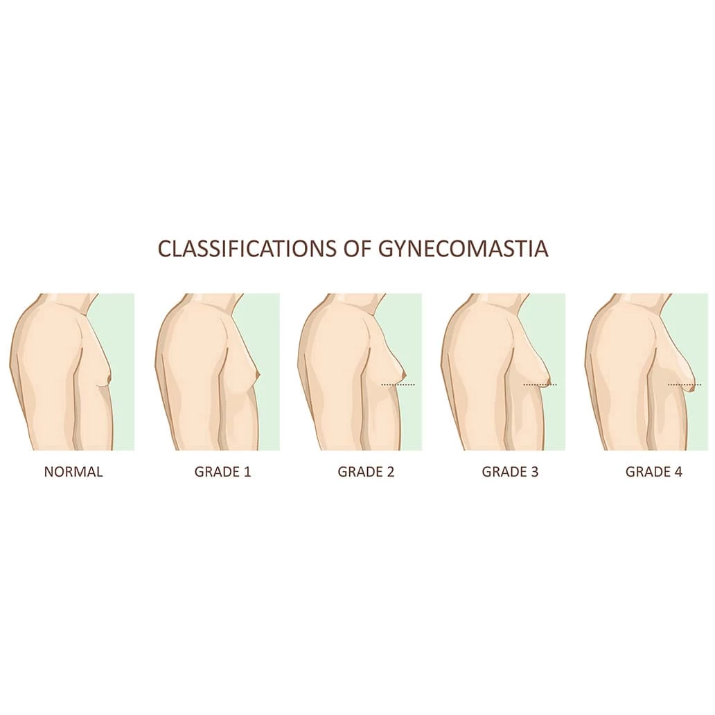 Gynecomastia