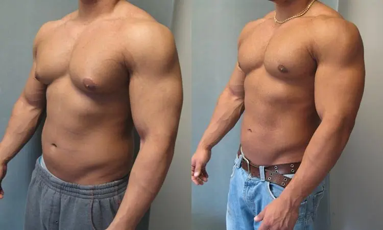 Gynecomastia gynecomastia